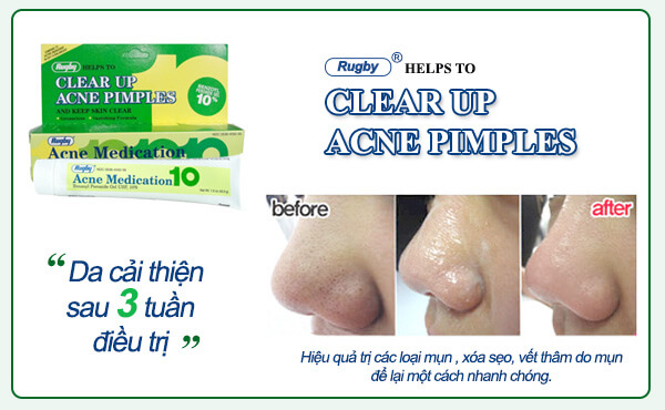 Top 5 kem trị mụn hiệu quả nhất hiện nay