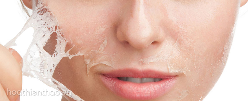 Những lý do nên trị nám vào mùa đông - Hoa Thiên Thảo