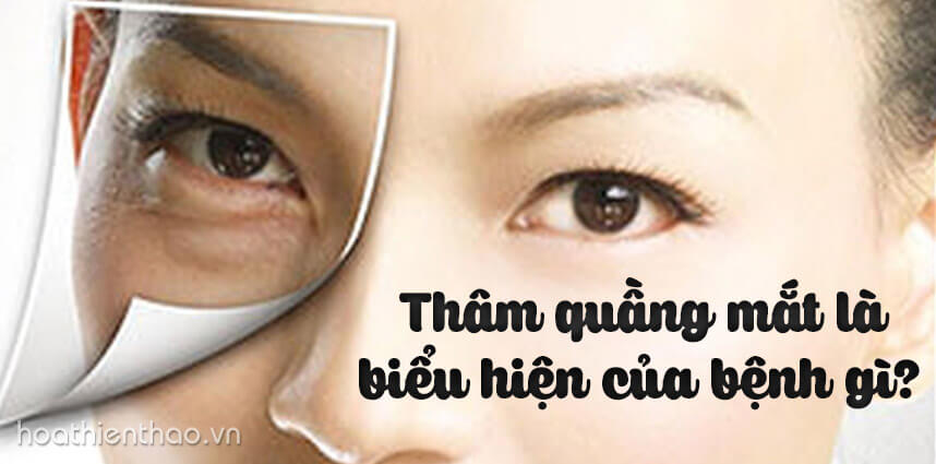 Thâm quầng mắt là biểu hiện của bệnh gì - Hoa Thien Thao Cosmetics