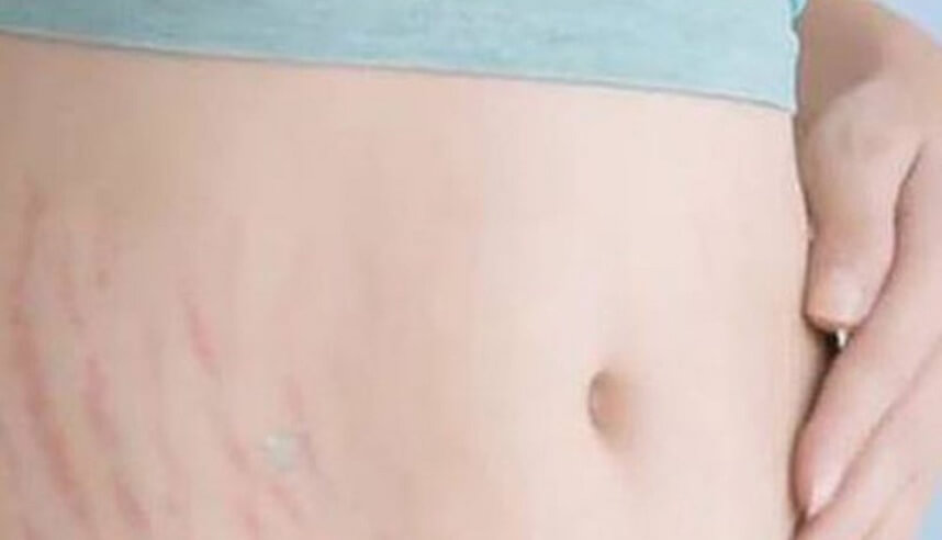 Rạn da là gì Trị rạn da bằng cách nào hiệu quả - Hoa Thien Thao