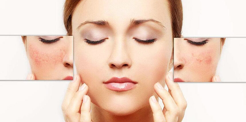 Da bị nhiễm corticoid là gì - HoaThienThao