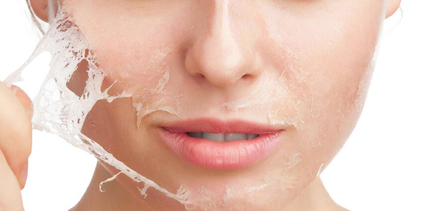 Da bị nhiễm corticoid là gì - HoaThienThao