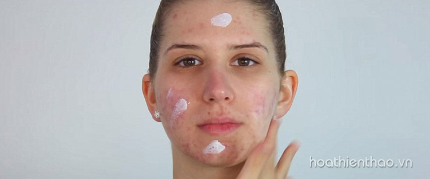 Da mặt nhờn rít nguyên nhân và cách điều trị - hoathienthaovn