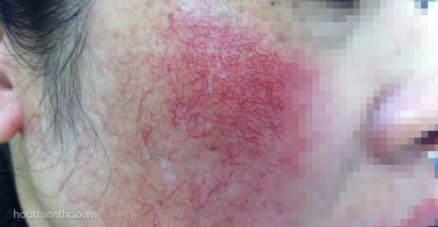 Hình ảnh da sau khi dùng kem trộn - HoaThienThao