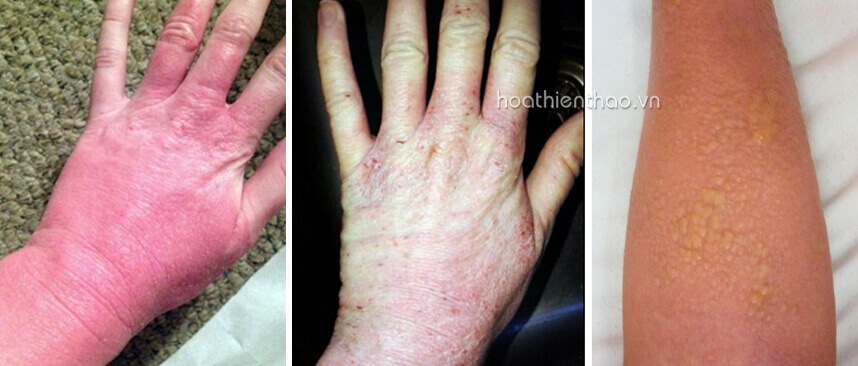 Hình ảnh da sau khi dùng kem trộn - HoaThienThao