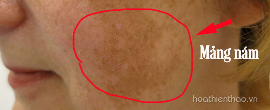 Nám mảng là gì Nguyên nhân và cách điều trị hiệu quả - Hoa Thiên Thảo