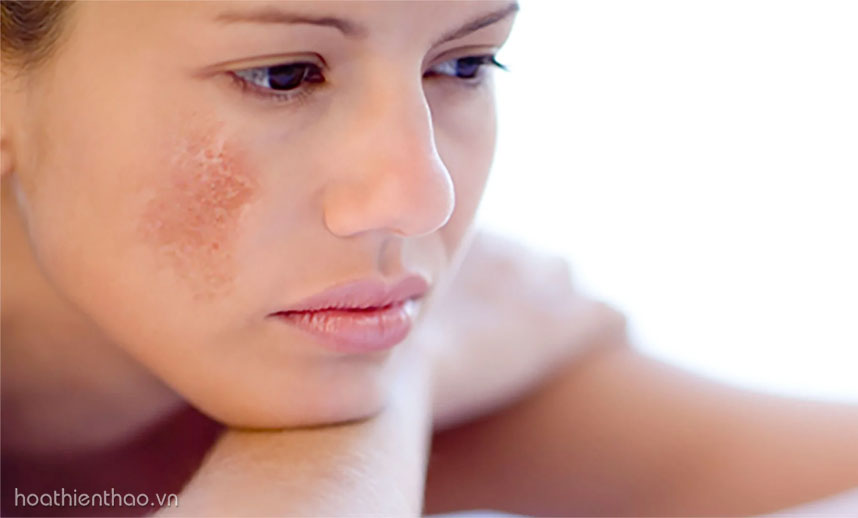 Vùng da nào trên mặt dễ bị nám nhất?