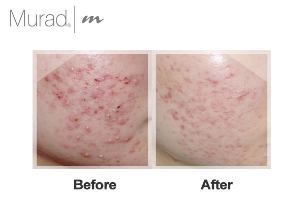 Trước và sau khi dùng Gel trị mụn cấp tốc Murad Acne Spot Treatment