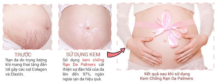 Kem chống rạn da Palmers Cocoa Butter Massage Cream Stretch Marks