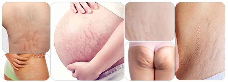 Kem chống rạn da Palmers Cocoa Butter Massage Cream Stretch Marks