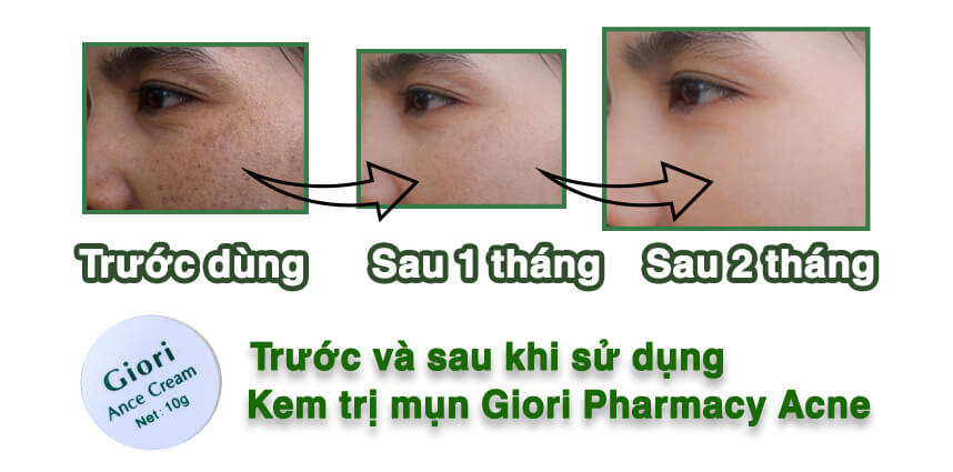 Kem trị mụn Giori Pharmacy Acne - Hoa Thiên Thảo